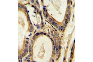 CCL4 antibody immunohistochemistry analysis in formalin fixed and paraffin embedded human prostate carcinoma. (CCL4 Antikörper  (AA 22-48))