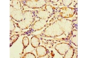 Immunohistochemistry of paraffin-embedded human gastric cancer using ABIN7147035 at dilution of 1:100 (CATSPER4 Antikörper  (AA 306-472))