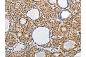 The image on the left is immunohistochemistry of paraffin-embedded Human thyroid cancer tissue using ABIN7189752(AKAP6 Antibody) at dilution 1/30, on the right is treated with synthetic peptide. (AKAP6 Antikörper)