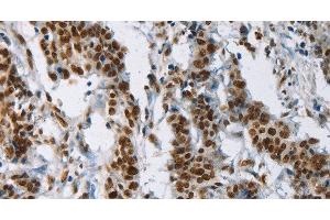Immunohistochemistry of paraffin-embedded Human gastic cancer using IL17C Polyclonal Antibody at dilution of 1:50 (IL17C Antikörper)