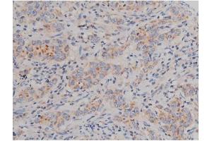 ABIN6267496 at 1/200 staining Human ganstric cancer tissue sections by IHC-P. (SNCA Antikörper  (pSer129))