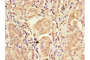 Immunohistochemistry of paraffin-embedded human liver cancer using ABIN7148885 at dilution of 1:100 (CDKN2B Antikörper  (AA 1-138))