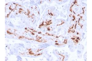 Formalin-fixed, paraffin-embedded human placenta stained with Factor 13A Recombinant Rabbit Monoclonal Antibody (F13A1/3772R). (Rekombinanter F13A1 Antikörper  (AA 46-181))