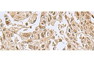 Immunohistochemistry of paraffin-embedded Human lung cancer tissue using NVL Polyclonal Antibody at dilution of 1:80(x200) (NVL Antikörper)