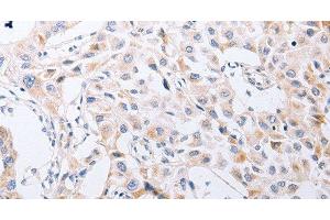 Immunohistochemistry of paraffin-embedded Human lung cancer tissue using SERP1 Polyclonal Antibody at dilution 1:30 (SERP1 Antikörper)