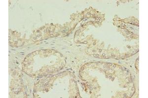 Immunohistochemistry of paraffin-embedded human prostate cancer using ABIN7173059 at dilution of 1:100 (TMEM141 Antikörper  (AA 1-108))