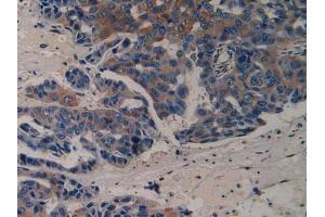 IHC-P analysis of Human Breast Cancer Tissue, with DAB staining. (VEGFR2/CD309 Antikörper  (AA 46-320))