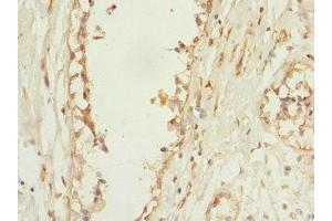 Immunohistochemistry of paraffin-embedded human breast cancer using ABIN7163649 at dilution of 1:100 (PLEKHF2 Antikörper  (AA 1-249))