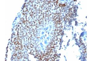 Formalin-fixed, paraffin-embedded human Bladder Carcinoma stained with p21 Mouse Monoclonal Antibody (CIP1/823). (p21 Antikörper)