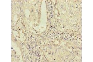 Immunohistochemistry of paraffin-embedded human lung cancer using ABIN7163315 at dilution of 1:100 (PLAA Antikörper  (AA 536-795))
