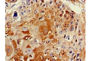 Immunohistochemistry of paraffin-embedded human cervical cancer using ABIN7171915 at dilution of 1:100 (TTC19 Antikörper  (AA 108-380))