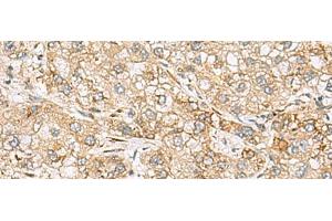 Immunohistochemistry of paraffin-embedded Human liver cancer tissue using SH3GL2 Polyclonal Antibody at dilution of 1:80(x200) (SH3G2 Antikörper)