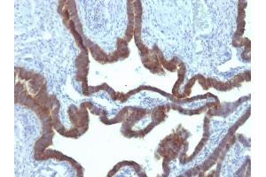 Formalin-fixed, paraffin-embedded human Ovarian Carcinoma stained with Cytokeratin 7 Mouse Monoclonal Antibody (KRT7/903) (Cytokeratin 7 Antikörper)