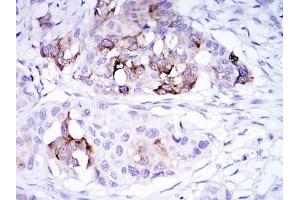 Immunohistochemical analysis of paraffin-embedded mammary cancer tissues using SCGB2A2 antibody with DAB staining. (Mammaglobin A Antikörper)
