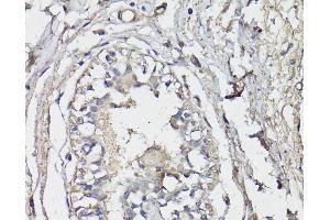 Immunohistochemistry of paraffin-embedded Human breast using BAP1 Polyclonal Antibody at dilution of 1:150 (40x lens). (BAP1 Antikörper)