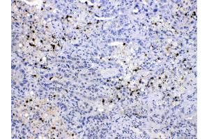 NEDD8 was detected in paraffin-embedded sections of human lung cancer tissues using rabbit anti- NEDD8 Antigen Affinity purified polyclonal antibody (Catalog # ) at 1 µg/mL. (NEDD8 Antikörper  (Middle Region))