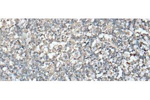 Immunohistochemistry of paraffin-embedded Human tonsil tissue using VASP Polyclonal Antibody at dilution of 1:30(x200) (VASP Antikörper)