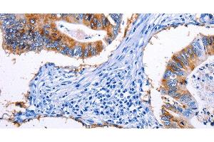 Immunohistochemistry of paraffin-embedded Human colon cancer tissue using EPCAM Polyclonal Antibody at dilution 1:45 (EpCAM Antikörper)