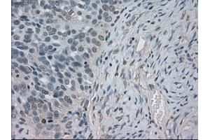 Immunohistochemical staining of paraffin-embedded Adenocarcinoma of ovary tissue using anti-SLC2A5mouse monoclonal antibody. (SLC2A5 Antikörper)