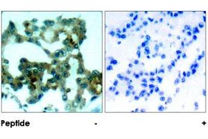 Immunohistochemical analysis of paraffin-embedded human lung carcinoma tissue using PRKCB polyclonal antibody .