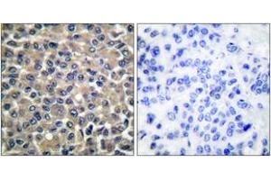 Immunohistochemistry analysis of paraffin-embedded human breast carcinoma tissue, using MMP-19 Antibody. (MMP19 Antikörper  (AA 11-60))