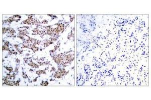 Immunohistochemical analysis of paraffin-embedded human breast carcinoma tissue using MEF2A(Phospho-Thr312) Antibody(left) or the same antibody preincubated with blocking peptide(right). (MEF2A Antikörper  (pThr312))