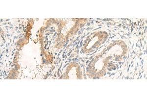 Immunohistochemistry of paraffin-embedded Human cervical cancer tissue using GPR89A/GPR89B Polyclonal Antibody at dilution of 1:25(x200) (GPR89A Antikörper)