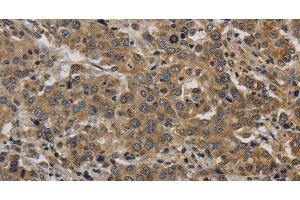 Immunohistochemistry of paraffin-embedded Human liver cancer tissue using KIF4A Polyclonal Antibody at dilution 1:40