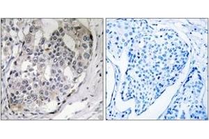 Immunohistochemistry analysis of paraffin-embedded human breast carcinoma, using DARPP-32 (Phospho-Thr75) Antibody.