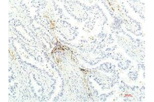 Immunohistochemical analysis of paraffin-embedded Human Lung Carcinoma Tissue using JAK1 Mouse mAb diluted at 1:200. (JAK1 Antikörper  (AA 960-1040))