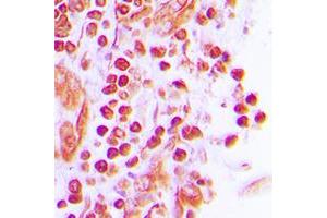 Immunohistochemical analysis of JUNB staining in human breast cancer formalin fixed paraffin embedded tissue section. (JunB Antikörper  (C-Term))