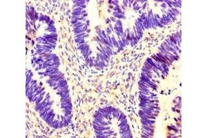 Immunohistochemistry of paraffin-embedded human ovarian cancer using ABIN7142095 at dilution of 1:100 (14-3-3 gamma Antikörper  (AA 113-194))