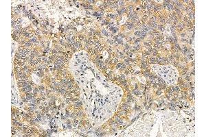 Cytokeratin 17 Mouse Monoclonal Antibody at 1/100 staining human lung cancer and adjacent non-tumor tissue by IHC-P. (KRT17 Antikörper  (Internal Region))