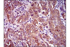 Immunohistochemical analysis of paraffin-embedded endometrial cancer tissues using CLGN mouse mAb with DAB staining. (Calmegin Antikörper  (AA 249-405))
