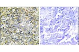 Immunohistochemistry analysis of paraffin-embedded human lung carcinoma tissue, using UBXD5 Antibody.