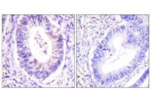Immunohistochemistry analysis of paraffin-embedded human colon carcinoma tissue using p90 RSK (epitope around residue 573) antibody. (RPS6KA3 Antikörper  (Thr573))