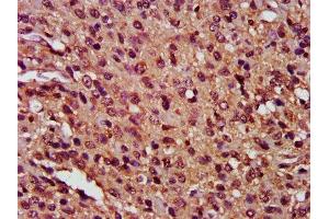 IHC image of ABIN7146901 diluted at 1:400 and staining in paraffin-embedded human glioma performed on a Leica BondTM system. (FLIP Antikörper  (AA 1-250))