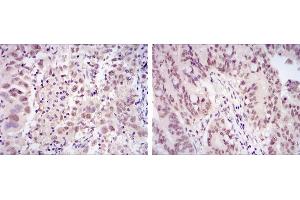 Immunohistochemical analysis of paraffin-embedded endometrial cancer tissues (left) and rectum cancer tissues (right) using CDK9 mouse mAb with DAB staining. (CDK9 Antikörper)