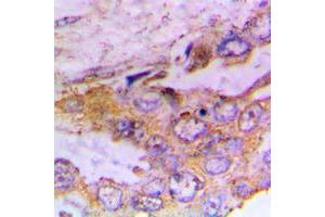 Immunohistochemical analysis of CaMK1 alpha (pT177) staining in human lung cancer formalin fixed paraffin embedded tissue section.