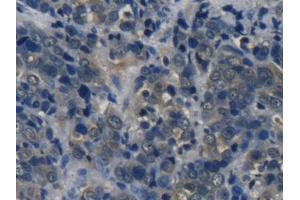 IHC-P analysis of Human Thyroid cancer Tissue, with DAB staining. (Tyrosine Hydroxylase Antikörper  (AA 82-310))
