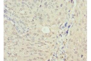 Immunohistochemistry of paraffin-embedded human lung cancer using ABIN7161740 at dilution of 1:100 (NSFL1C Antikörper  (AA 1-185))