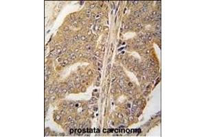 Formalin-fixed and paraffin-embedded human prostata carcinoma tissue reacted with PXN Antibody  (ABIN390376 and ABIN2840778) , which was peroxidase-conjugated to the secondary antibody, followed by DAB staining. (Paxillin Antikörper  (AA 94-125))