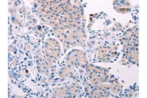 The image on the left is immunohistochemistry of paraffin-embedded Human lung cancer tissue using ABIN7131321(TEKT4 Antibody) at dilution 1/10, on the right is treated with fusion protein. (Tektin 4 Antikörper)
