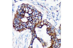 Immunohistochemistry of paraffin-embedded Human colon carcinoma using [KO Validated] CHCHD2 Rabbit pAb (ABIN7266448) at dilution of 1:100 (40x lens). (CHCHD2 Antikörper  (AA 75-145))