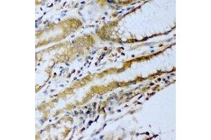 Immunohistochemical analysis of ERG staining in human stomach cancer formalin fixed paraffin embedded tissue section. (ERG Antikörper)