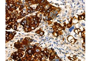 Phospho-MAP3K8/COT (Ser443) Antibody at 1/100 staining Human ovarian cancer by IHC-P. (MAP3K8 Antikörper  (pSer443))