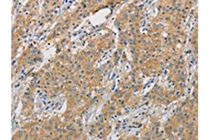 The image on the left is immunohistochemistry of paraffin-embedded Human gastric cancer tissue using ABIN7128504(ARHGEF7 Antibody) at dilution 1/40, on the right is treated with fusion protein. (ARHGEF7 Antikörper)