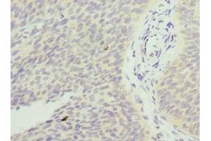 Immunohistochemistry of paraffin-embedded human cervical cancer using ABIN7153251 at dilution of 1:100 (FXYD5 Antikörper  (AA 22-145))