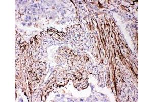 IHC-P: ADAM19 antibody testing of human lung cancer tissue (ADAM19 Antikörper  (N-Term))