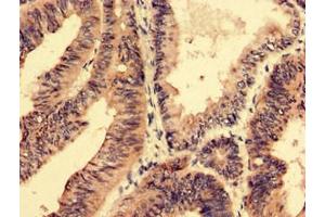 Immunohistochemistry analysis of human colon cancer using ABIN7168686 at dilution of 1:100 (SFRP4 Antikörper  (AA 293-346))